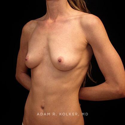 Breast Augmentation Before Image Patient 25 Oblique View