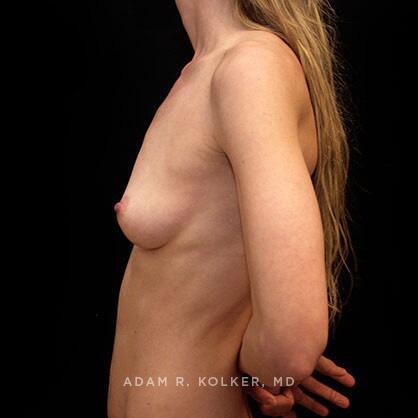 Breast Augmentation Before Image Patient 25 Side View