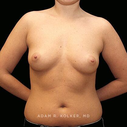 Breast Augmentation Before Image Patient 28 Front View
