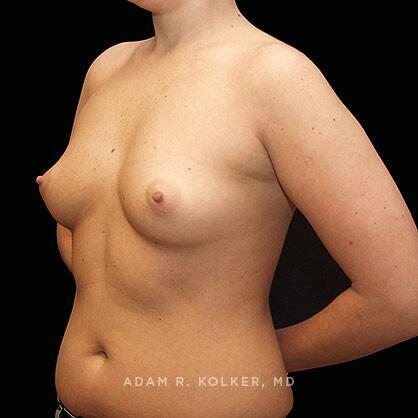 Breast Augmentation Before Image Patient 28 Oblique View
