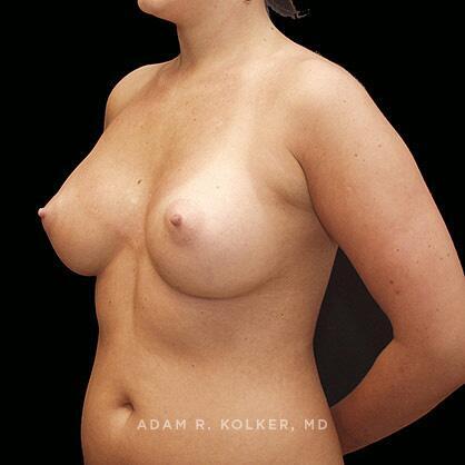 Breast Augmentation After Image Patient 28 Oblique View