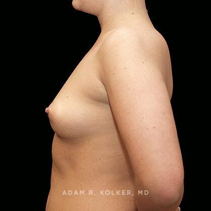Breast Augmentation Before Image Patient 28 Side View