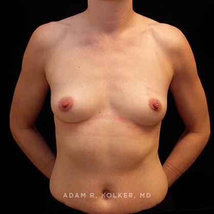 Breast Augmentation Before Image Patient 29 Front View