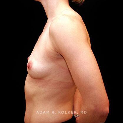 Breast Augmentation Before Image Patient 29 Side View
