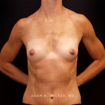 Breast Augmentation Before Image Patient 30 Front View