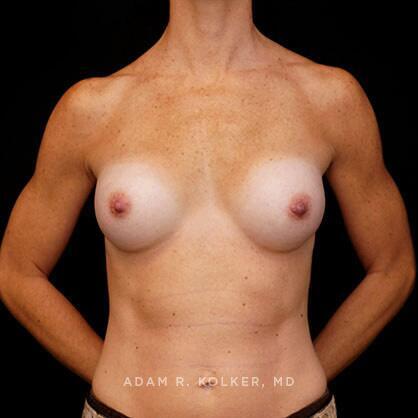 Breast Augmentation After Image Patient 30 Front View