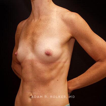 Breast Augmentation Before Image Patient 30 Oblique View