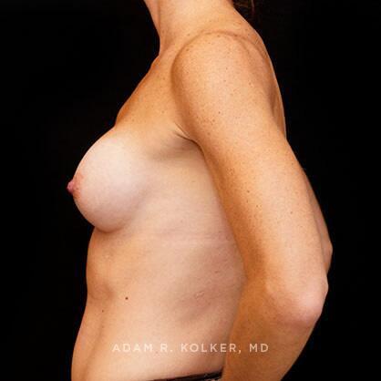 Breast Augmentation After Image Patient 30 Side View