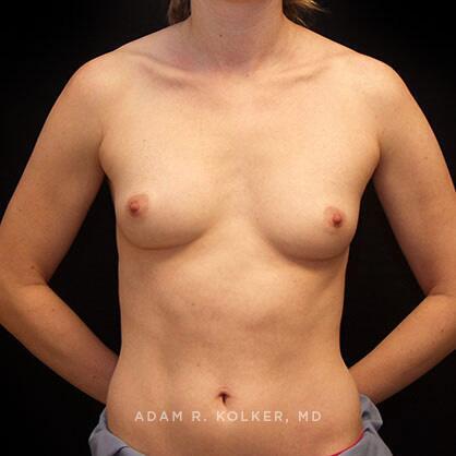 Breast Augmentation Before Image Patient 31 Front View