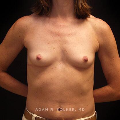 Breast Augmentation Before Image Patient 33 Front View