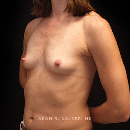 Breast Augmentation Before Image Patient 33 Oblique View