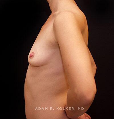 Breast Augmentation Before Image Patient 34 Side View