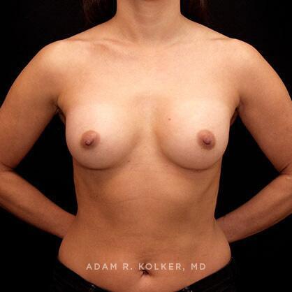 Breast Augmentation After Image Patient 35 Front View