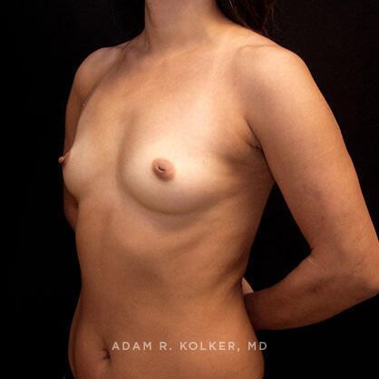 Breast Augmentation Before Image Patient 35 Oblique View