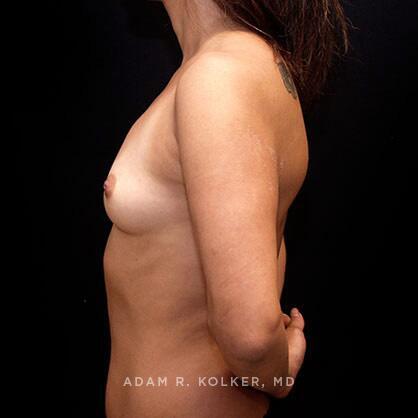 Breast Augmentation Before Image Patient 35 Side View
