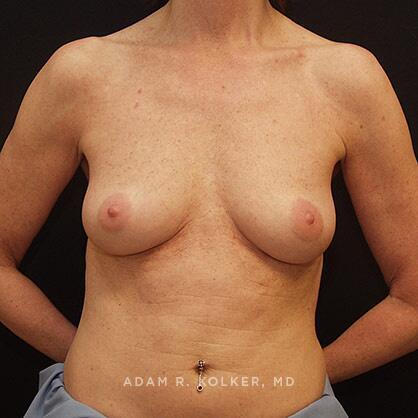 Breast Augmentation Before Image Patient 36 Front View