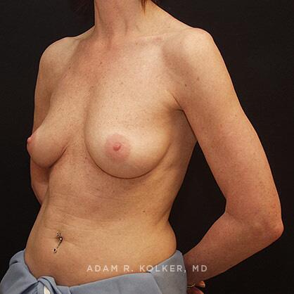 Breast Augmentation Before Image Patient 36 Oblique View