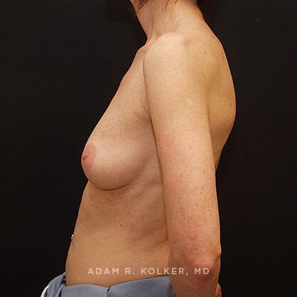 Breast Augmentation Before Image Patient 36 Side View