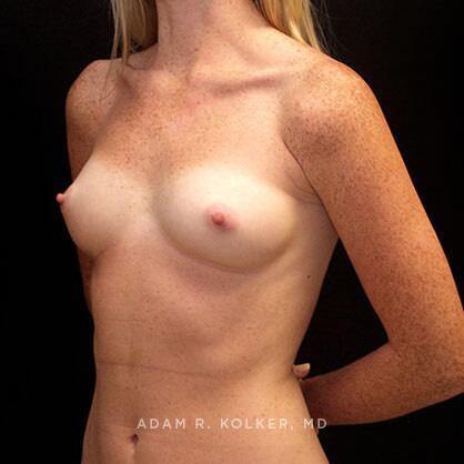 Breast Augmentation Before Image Patient 37 Oblique View
