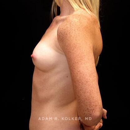 Breast Augmentation Before Image Patient 37 Side View