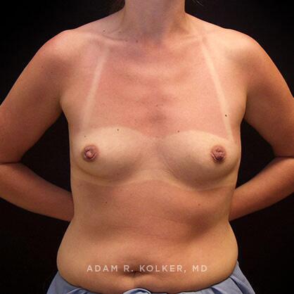 Breast Augmentation Before Image Patient 38 Front View