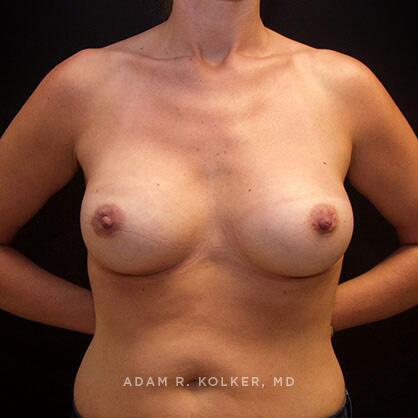 Breast Augmentation After Image Patient 38 Front View