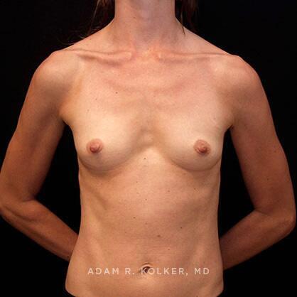 Breast Augmentation Before Image Patient 39 Front View