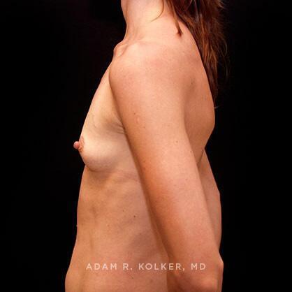 Breast Augmentation Before Image Patient 39 Side View