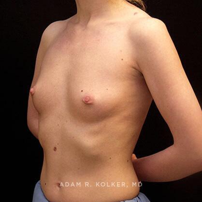 Breast Augmentation Before Image Patient 41 Oblique View