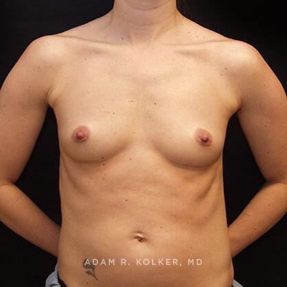 Breast Augmentation Before Image Patient 43 Front View
