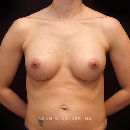 Breast Augmentation After Image Patient 43 Front View
