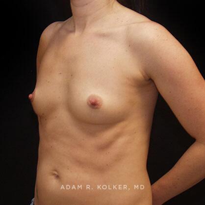 Breast Augmentation Before Image Patient 43 Oblique View