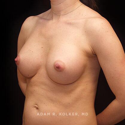 Breast Augmentation After Image Patient 43 Oblique View