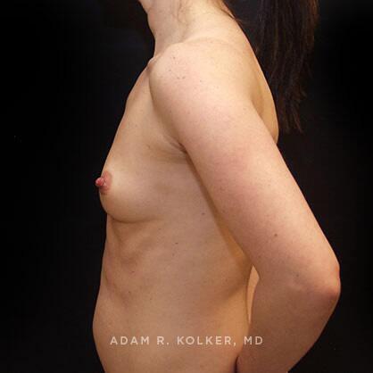 Breast Augmentation Before Image Patient 43 Side View