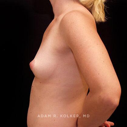 Breast Augmentation Before Image Patient 46 Side View