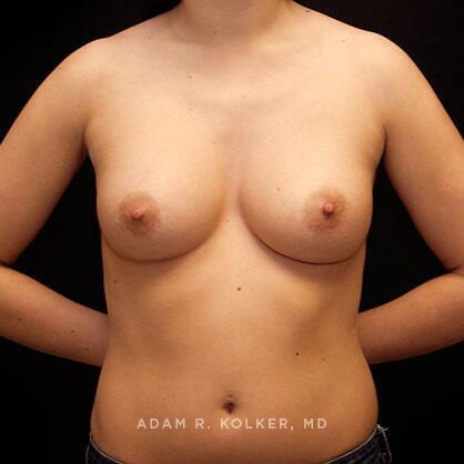 Breast Augmentation After Image Patient 47 Front View