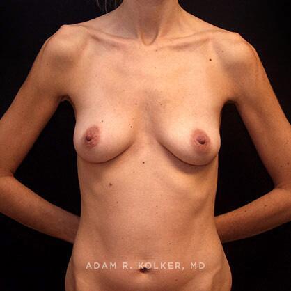 Breast Augmentation Before Image Patient 48 Front View