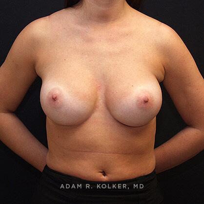 Breast Augmentation After Image Patient 49 Front View