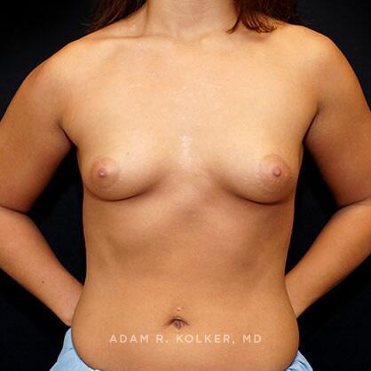 Breast Augmentation Before Image Patient 50 Front View