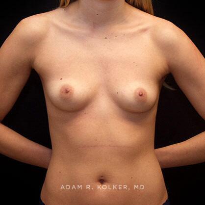 Breast Augmentation Before Image Patient 53 Front View