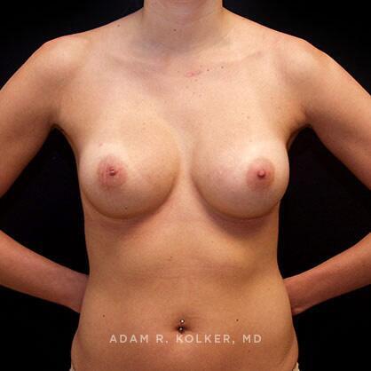 Breast Augmentation After Image Patient 53 Front View