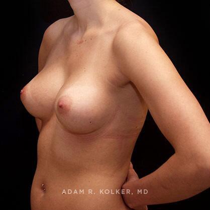 Breast Augmentation After Image Patient 53 Oblique View