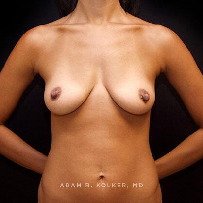 Breast Augmentation Before Image Patient 54 Front View