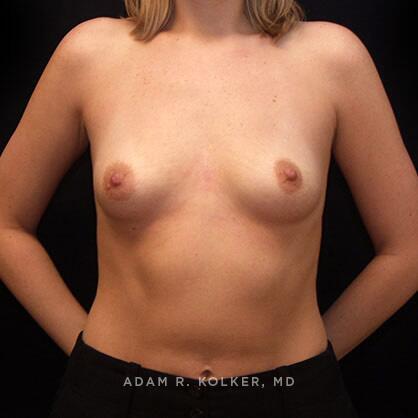 Breast Augmentation Before Image Patient 56 Front View