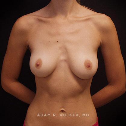 Breast Augmentation Before Image Patient 57 Front View