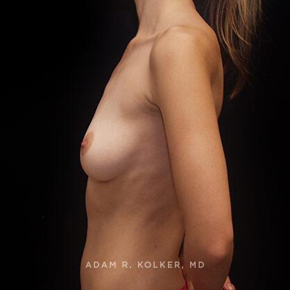 Breast Augmentation Before Image Patient 57 Side View