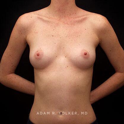 Breast Augmentation Before Image Patient 58 Front View