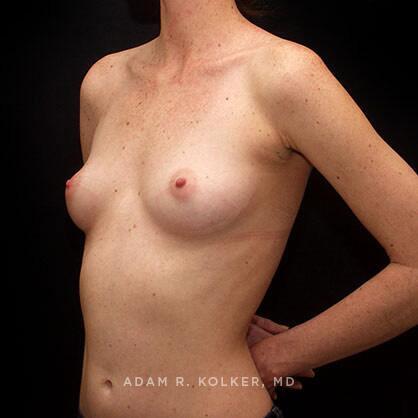Breast Augmentation Before Image Patient 58 Oblique View