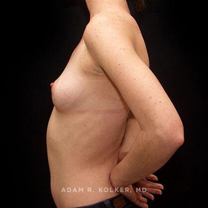 Breast Augmentation Before Image Patient 58 Side View