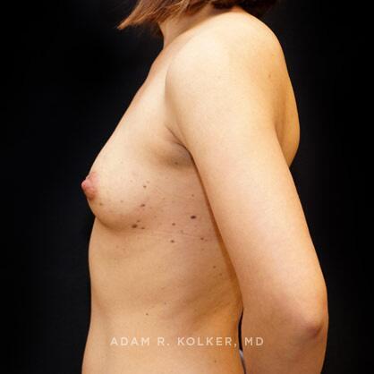 Breast Augmentation Before Image Patient 59 Side View